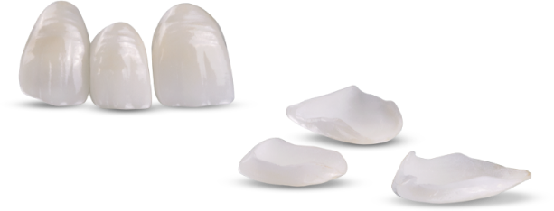 Dental Veneers