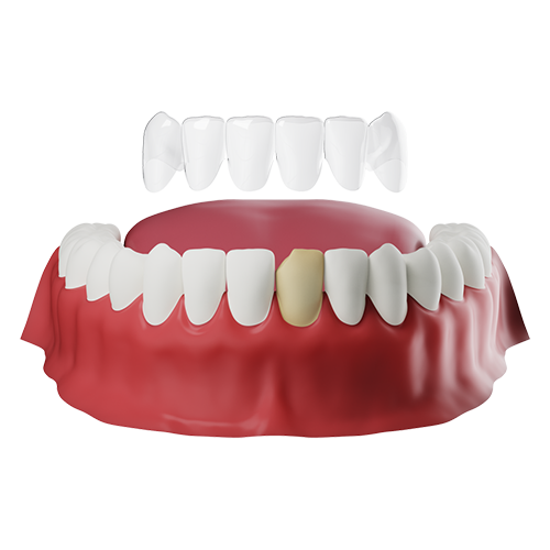 Dental Veneers