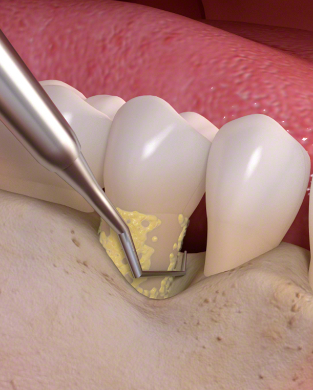 Teeth Scaling