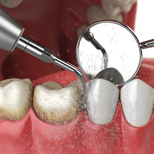 Teeth Scaling