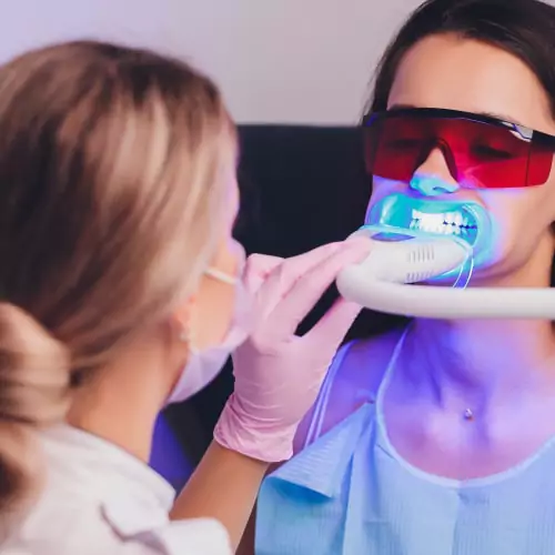 Laser Teeth Whitening treatment in Sri Lanka