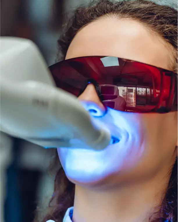 Laser Teeth Whitening treatment in Sri Lanka